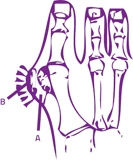 Hallux Abducto Valgus Slijmbeurs Grote Teen Podotherapie Reggestreek Rijssen Hallux Abducto Valgus Slijmbeurs Grote Teen Podotherapie Reggestreek Rijssen