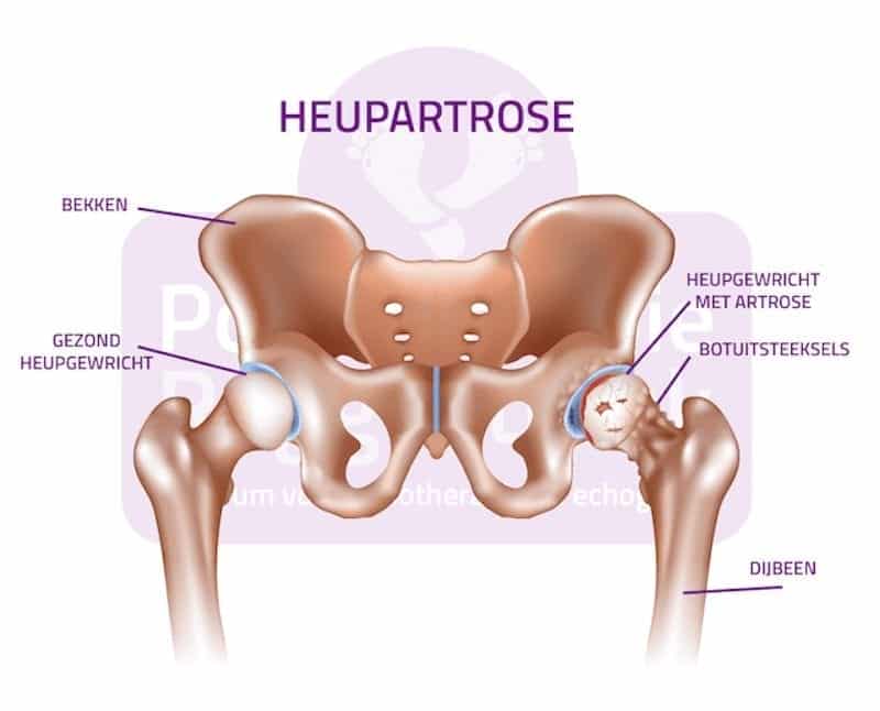 Heupartrose Podotherapie Reggestreek Rijssen Heupartrose Podotherapie Reggestreek Rijssen