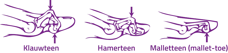 Klauwtenen Hamertenen Mallet teen Podotherapie Reggestreek Rijssen Klauwtenen Hamertenen Mallet teen Podotherapie Reggestreek Rijssen