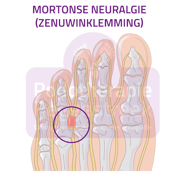 Mortonse Neuralgie Zenuwinklemming Voet Podotherapie Reggestreek Rijssen Mortonse Neuralgie Zenuwinklemming Voet Podotherapie Reggestreek Rijssen