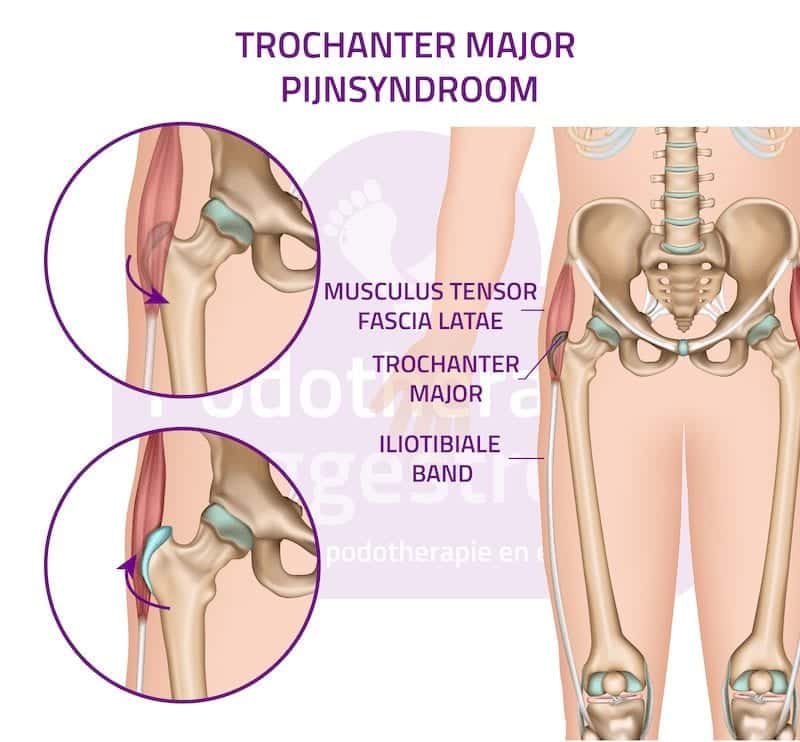 Pijn Buitenkant Heup Trochanter Major Pijnsyndroom Bursitis Trochanterica.png Pijn Buitenkant Heup Trochanter Major Pijnsyndroom Bursitis Trochanterica.png