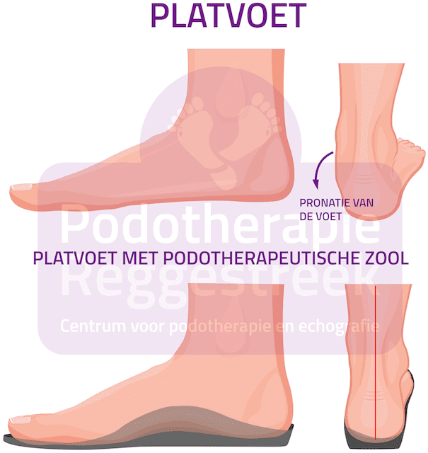 Platvoet Overpronatie Voet Podotherapie Reggestreek Rijssen Platvoet Overpronatie Voet Podotherapie Reggestreek Rijssen