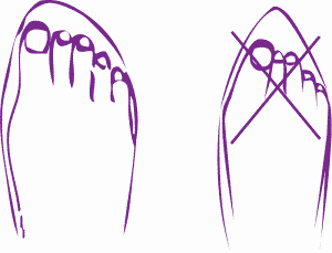 Schoenadvies Hallux Abducto Valgus Podotherapie Reggestreek Rijssen Schoenadvies Hallux Abducto Valgus Podotherapie Reggestreek Rijssen