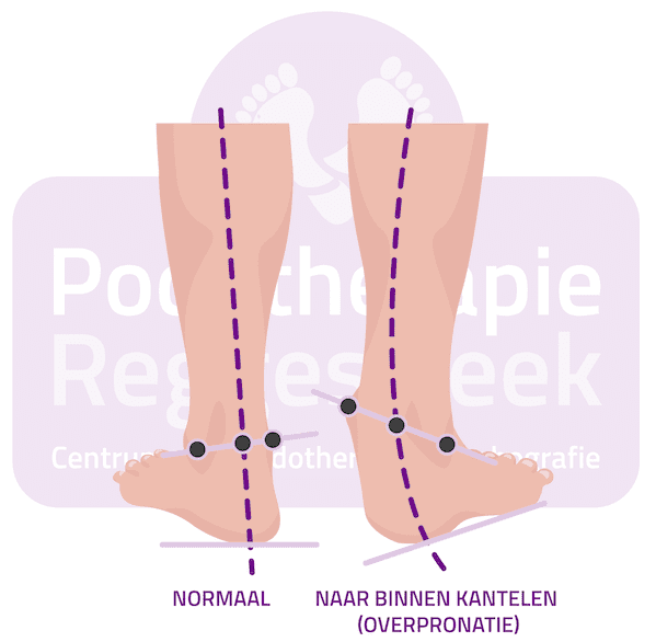 Stand van de voet pronatie normaal Podotherapie Reggestreek Rijssen Stand van de voet pronatie normaal Podotherapie Reggestreek Rijssen