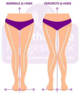 Vergrote Q-Hoek Meidenknie Retropatellaire Chondropatie Patellofemoraal Pijnsyndroom Podotherapie Reggestreek Rijssen Vergrote Q-Hoek Meidenknie Retropatellaire Chondropatie Patellofemoraal Pijnsyndroom Podotherapie Reggestreek Rijssen