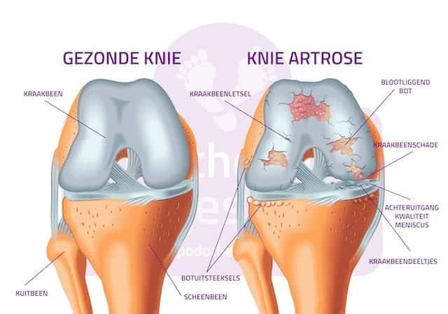 Artrose Knie Gonartrose Podotherapie Reggestreek Rijssen Artrose Knie Gonartrose Podotherapie Reggestreek Rijssen