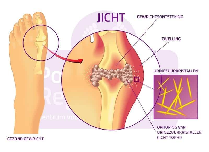 De Reumatische Voet Jicht Podotherapie Reggestreek Rijssen De Reumatische Voet Jicht Podotherapie Reggestreek Rijssen