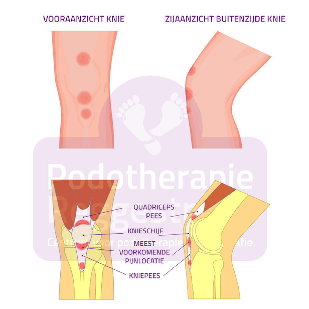 Springersknie Jumpers Knee Podotherapie Reggestreek Rijssen Springersknie Jumpers Knee Podotherapie Reggestreek Rijssen