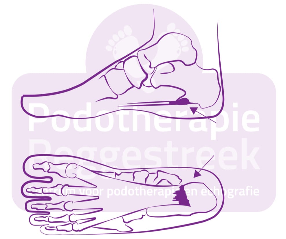Hielspoor Fasciitis Plantaris Podotherapie Reggestreek Rijssen Hielspoor Fasciitis Plantaris Podotherapie Reggestreek Rijssen