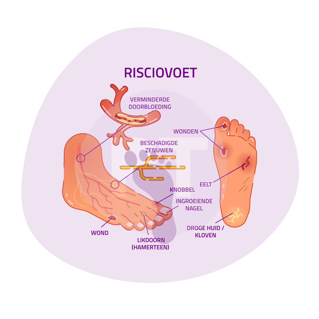 risicovoet-zorgmodule-preventie-voetulcera-2024-podotherapie-reggestreek Risicovoet Zorgmodule Preventie Voetulcera 2024 Podotherapie Reggestreek